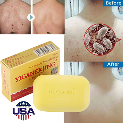 Sulfur Soap Mite Remover Soap Anti Fungal Scabies Acne Treatment Bath Soap 80g $10.85